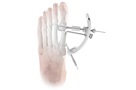 Hallux-valgus.jpg