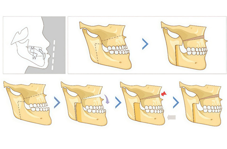 The Era of Precision Medicine in Minimally Invasive Maxillofacial Surgery